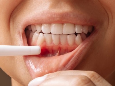 Periodontist in Rajajinagar