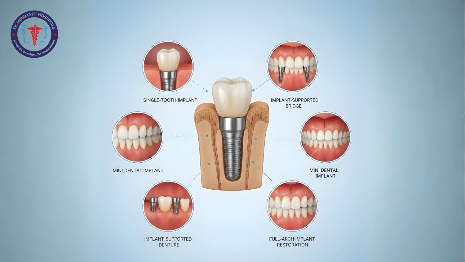 Affordable dental implants in Rajajinagar