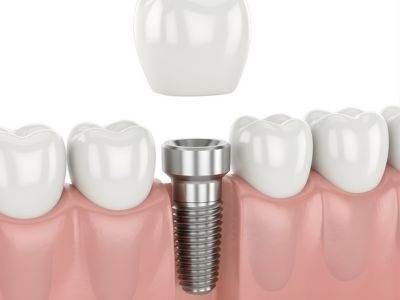Dental implant specialist in Bangalore