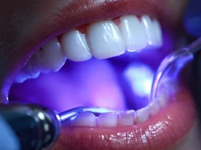 Lasers in dentistry in Rajajinagar