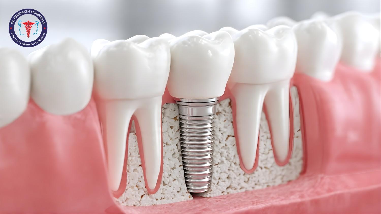 Single tooth implant in Rajajinagar