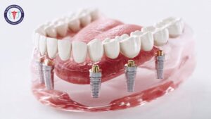 Dental Implants in Rajajinagar