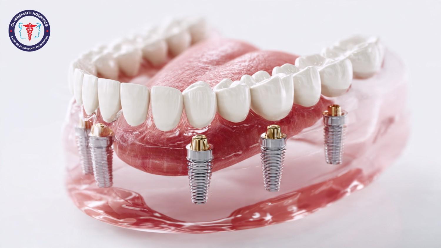 Dental Implants in Rajajinagar