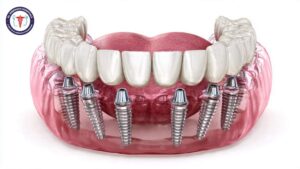 Full Mouth Dental Implants in Rajajinagar, Bangalore
