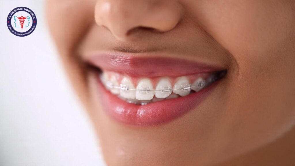 Ceramic Braces in Rajajinagar Bangalore