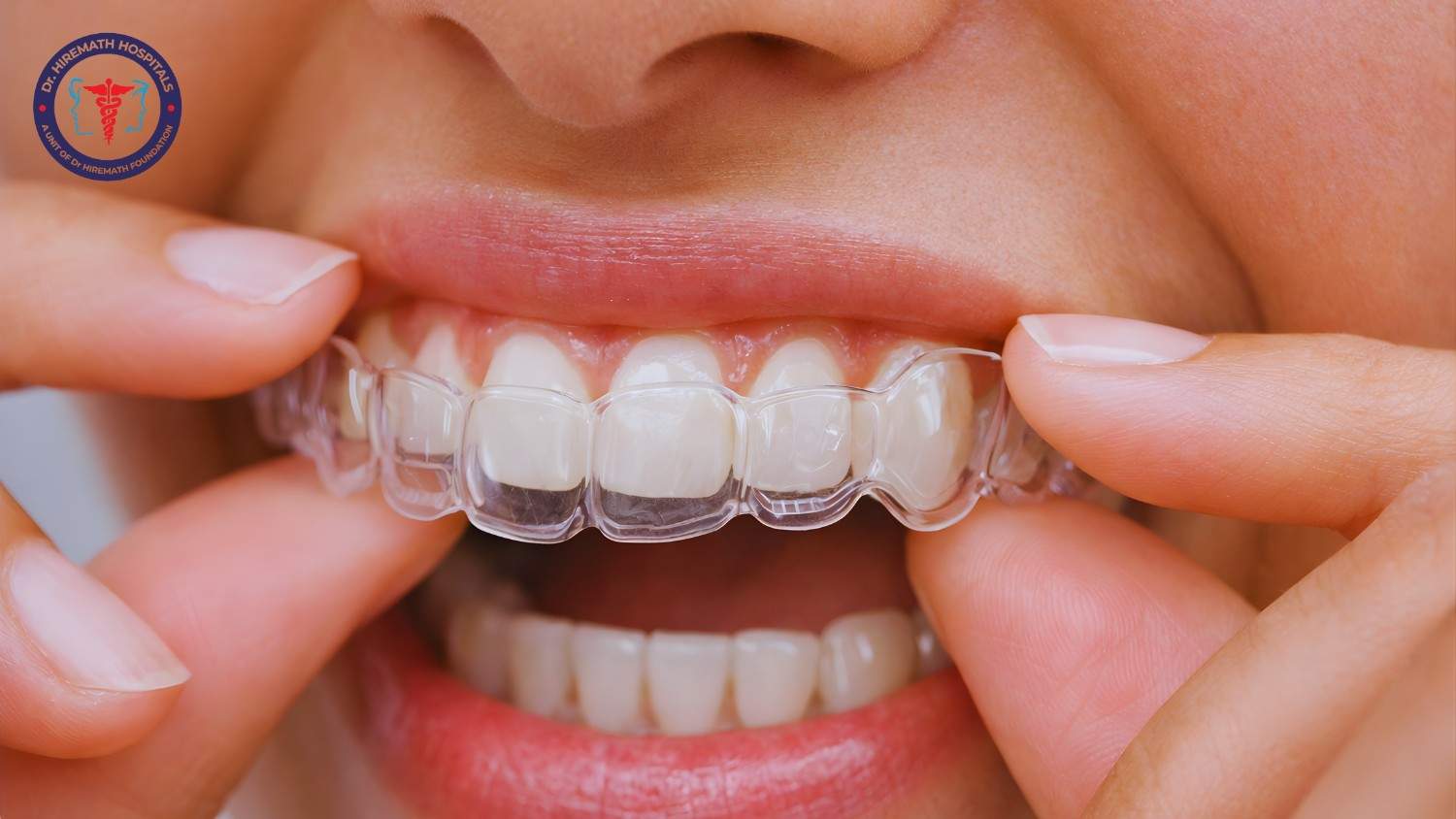 Clear Aligners in Rajajinagar