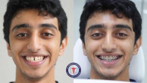 Metal Braces in Rajajinagar