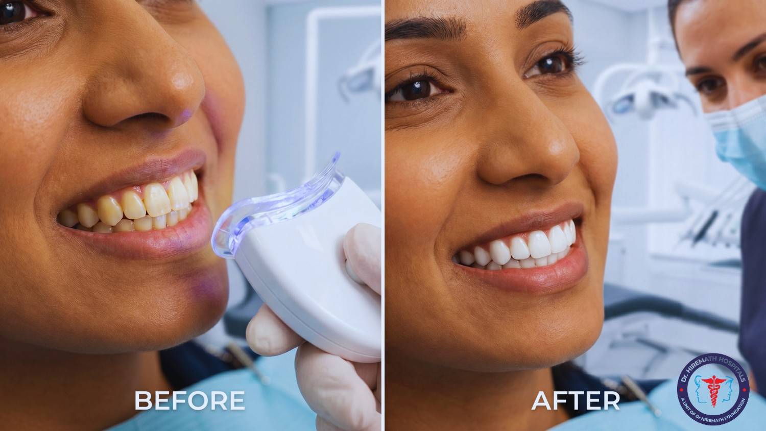 teeth whitening in rajajinagar, bangalore